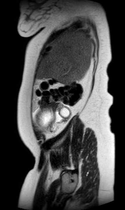 Colon adenocarcinoma with Krukenberg tumors, advanced pregnancy (Radiopaedia 67279-76645 Sagittal T2 43).jpg