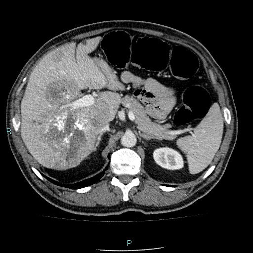 Colon adenocarcinoma with calcific liver metastasis (Radiopaedia 55745-62300 B 11).jpg