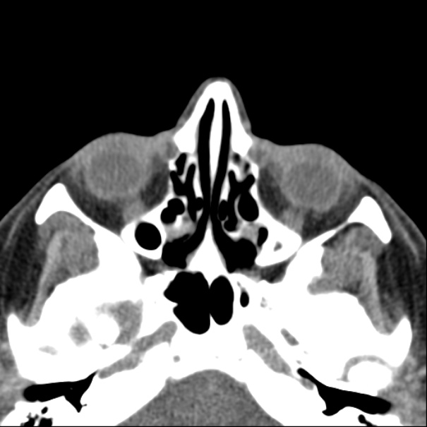 Nasolabial cyst (Radiopaedia 33987-35205 Axial non-contrast 28).jpg