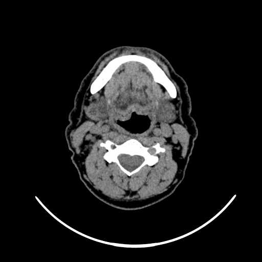File:Nasopharyngeal carcinoma - infiltrating the clivus (Radiopaedia 62583-70875 Axial non-contrast 39).jpg