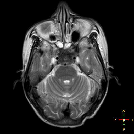 File:Nasopharyngeal carcinoma infiltrating the clivus (Radiopaedia 25229-25481 Axial T2 7).jpg