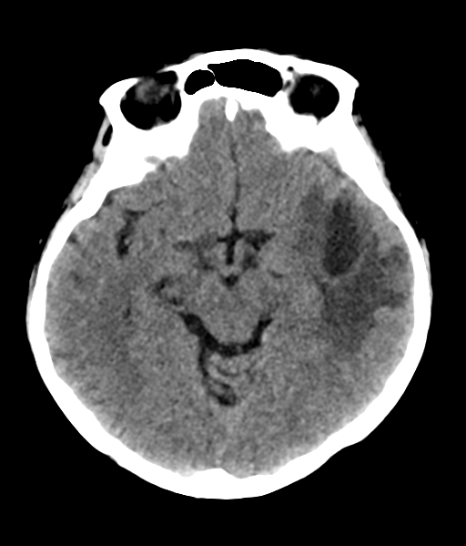 File:Nasopharyngeal carcinoma with cerebral abscess (Radiopaedia 43018-46275 Axial non-contrast 23).png