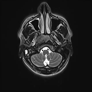 Nasopharyngeal carcinoma with perineural spread (Radiopaedia 55030-61380 Axial T2 27).jpg