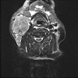 File:Nasopharyngeal carcinoma with skull base invasion (Radiopaedia 59258-66600 Axial T2 fat sat 3).jpg