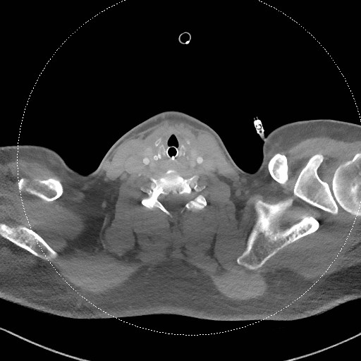 Neck CT angiogram (intraosseous vascular access) (Radiopaedia 55481-61945 B 146).jpg
