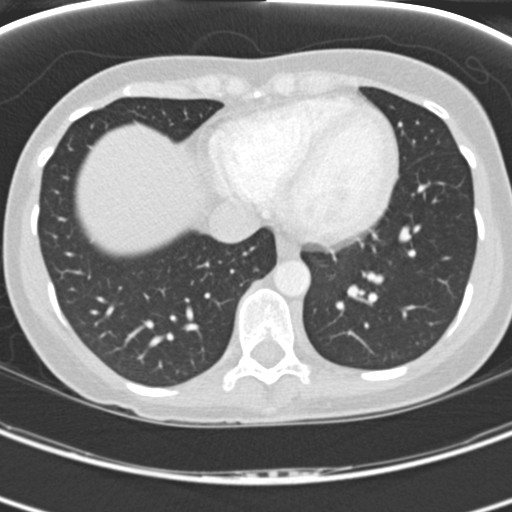 Necrobiotic pulmonary nodules - Crohn disease (Radiopaedia 20723-20631 Axial lung window 106).jpg