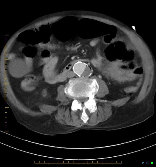 Necrotzing fasciitis due to a perforated adenocarcinoma of the splenic flexure (Radiopaedia 46930-51455 A 37).jpg