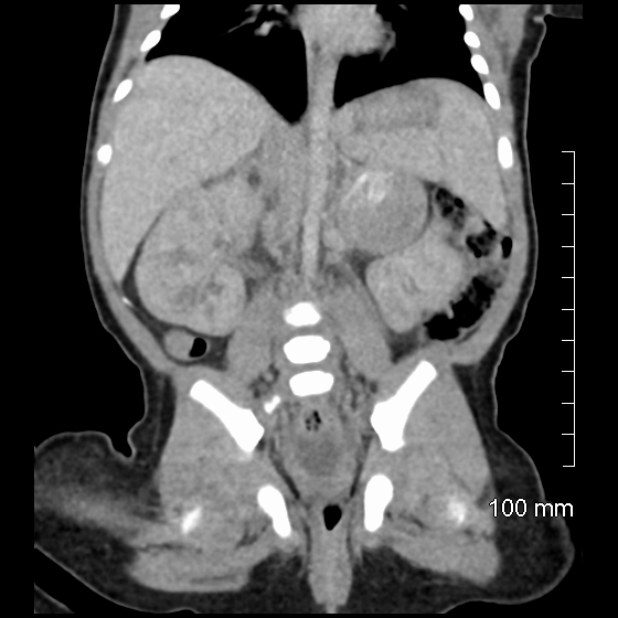 File:Neonatal neuroblastoma (Radiopaedia 56651-63438 Coronal non-contrast 32).jpg