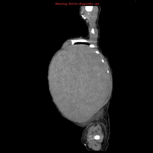 File:Neonatal neuroblastoma (Radiopaedia 9564-10223 C 23).jpg