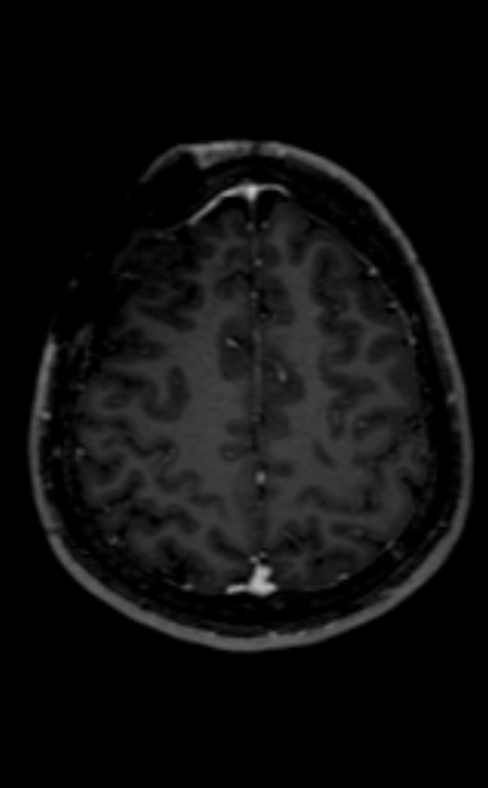 Neuro-Behçet disease (Radiopaedia 90112-107294 Axial T1 C+ 81).jpg
