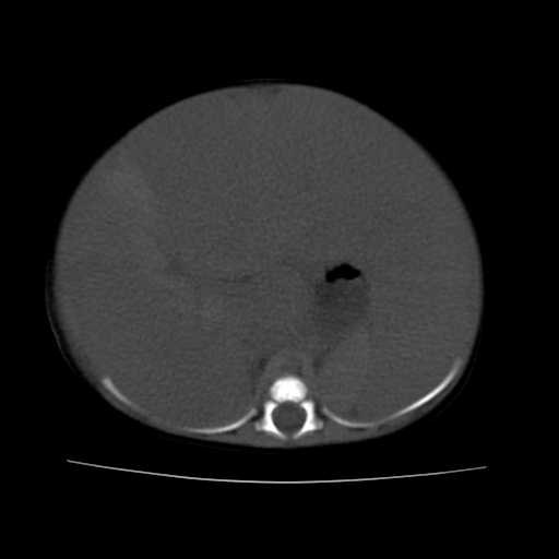 File:Neuroblastoma (Radiopaedia 20876-20799 Axial non-contrast 9).jpg