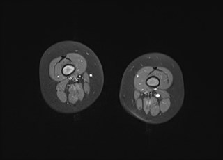 File:Neuroblastoma with bone metastases (Radiopaedia 67080-76414 Axial T1 C+ fat sat 19).jpg
