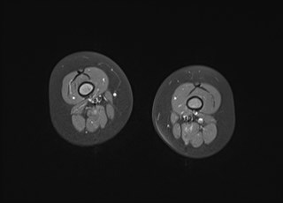 File:Neuroblastoma with bone metastases (Radiopaedia 67080-76414 Axial T1 C+ fat sat 20).jpg