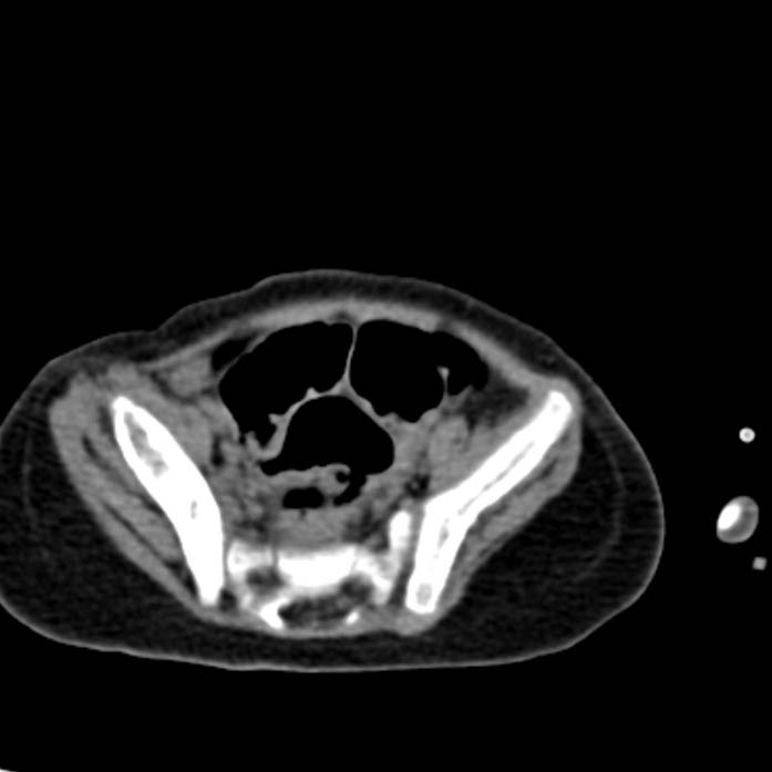 Neuroblastoma with skull metastases (Radiopaedia 30326-30960 Axial non-contrast 50).jpg