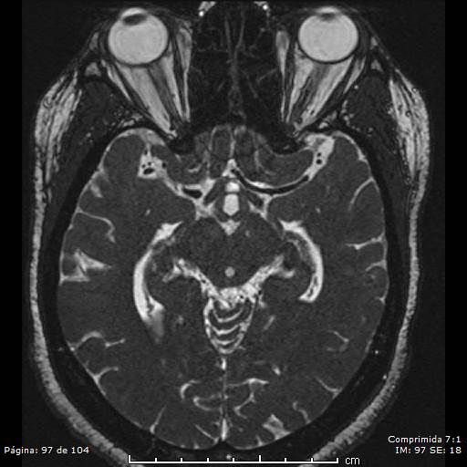Neurocysticercosis (Radiopaedia 58636-65832 I 97).jpg