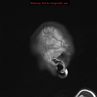 File:Neurofibromatosis type 1 with optic nerve glioma (Radiopaedia 16288-15965 Sagittal T1 23).jpg