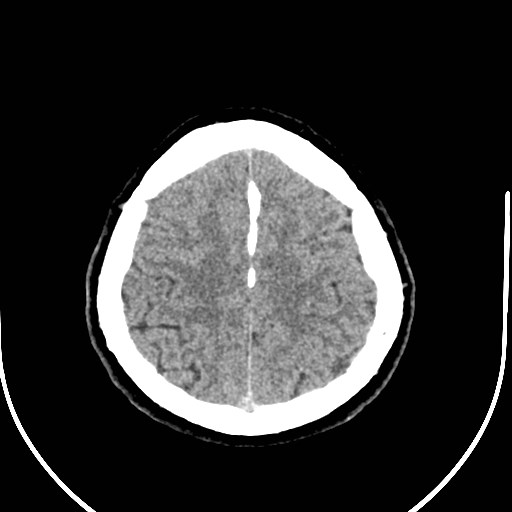 Neurofibromatosis type 2 (Radiopaedia 79097-92047 Axial non-contrast 50).jpg