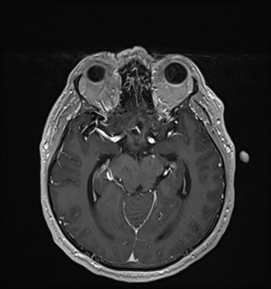 Neurofibromatosis type 2 (Radiopaedia 79097-92049 Axial T1 C+ 87).jpg