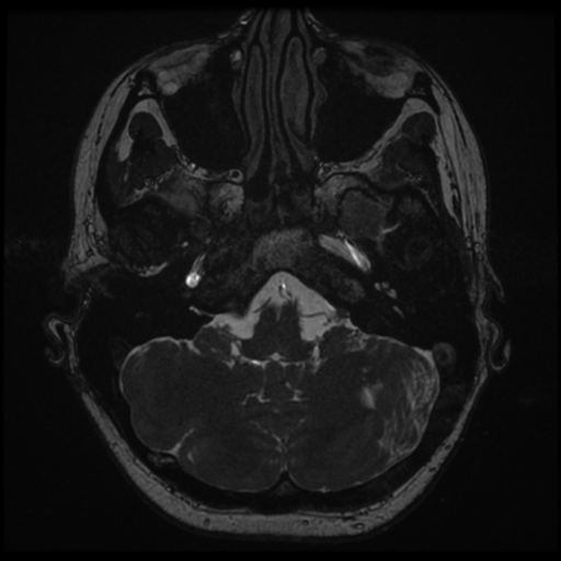 Neurofibromatosis type 2 - bilateral acoustic neuromata (Radiopaedia 40060-42566 Axial FIESTA 23).png