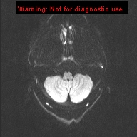File:Neuroglial cyst (Radiopaedia 10713-11184 Axial DWI 42).jpg