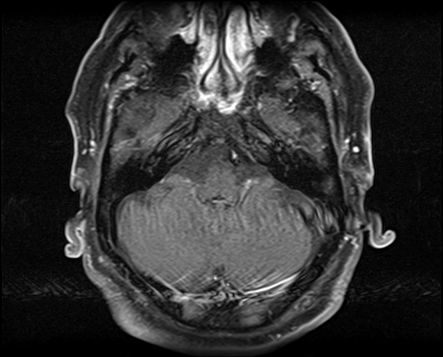File:Non-Hodgkin lymphoma - parotid gland (Radiopaedia 71531-81890 Axial T1 C+ fat sat 22).jpg