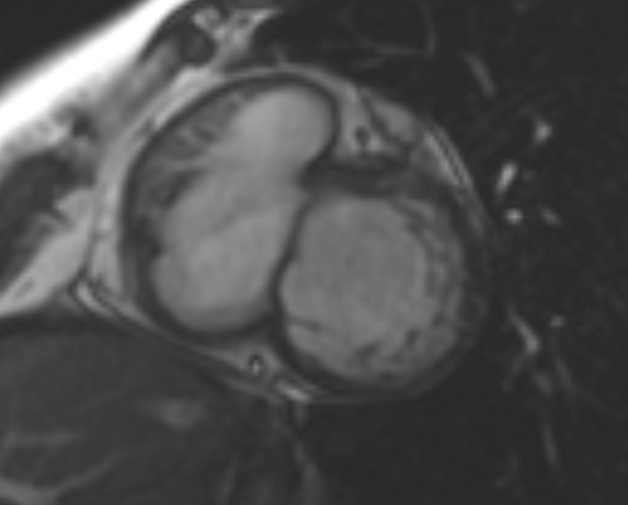File:Non-compaction of the left ventricle (Radiopaedia 69436-79314 Short axis cine 171).jpg