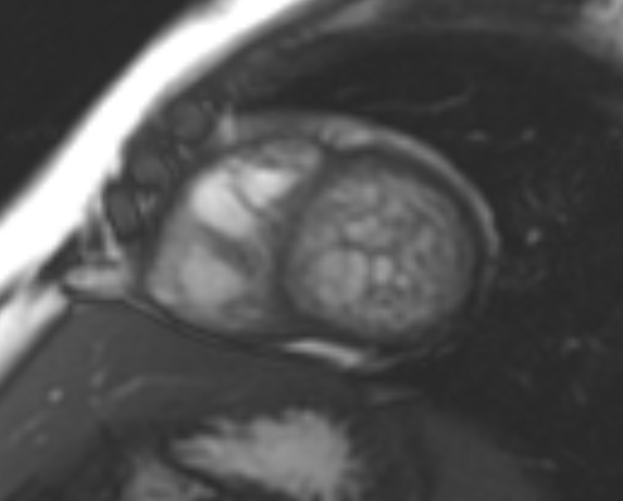 File:Non-compaction of the left ventricle (Radiopaedia 69436-79314 Short axis cine 99).jpg