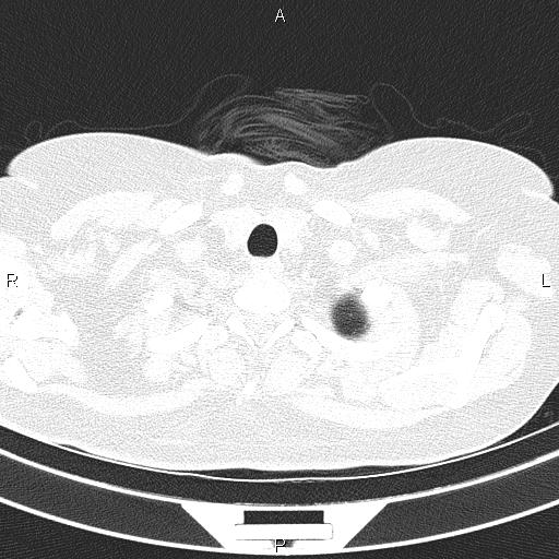 Non-specific interstitial pneumonia (Radiopaedia 83185-97567 Axial lung window 9).jpg
