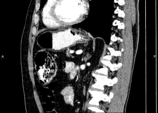Non-syndromic pancreatic endocrine tumor (Radiopaedia 86958-103178 E 63).jpg
