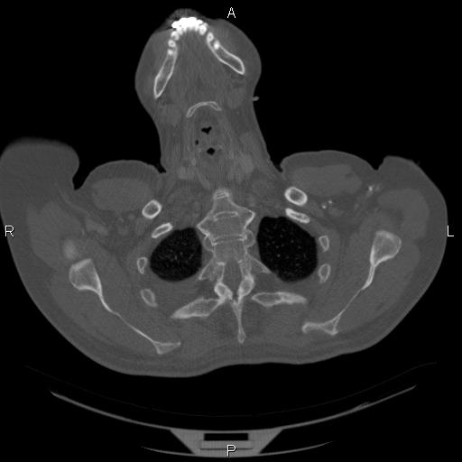 Non Hodgkin lymphoma in a patient with ankylosing spondylitis (Radiopaedia 84323-99624 Axial bone window 4).jpg