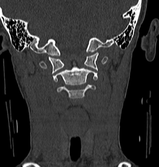 File:Normal CT cervical spine - 12-year-old (Radiopaedia 55352-61775 Coronal bone window 72).jpg