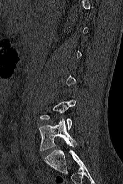 File:Normal CT lumbar spine (Radiopaedia 53981-60118 Sagittal bone window 27).jpg