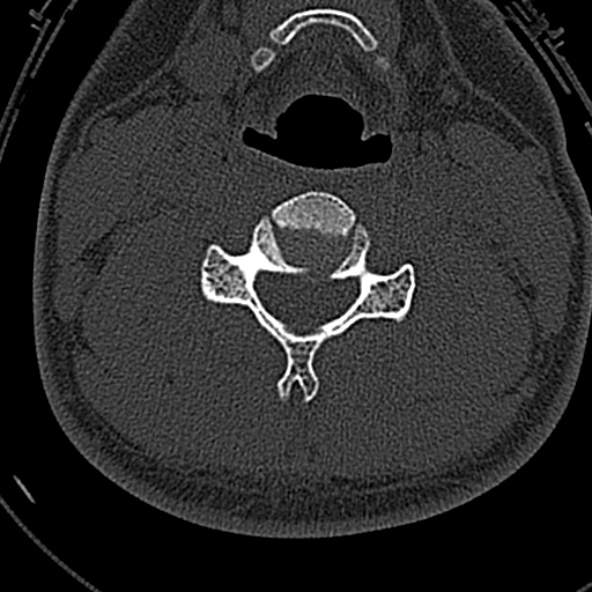 File:Normal CT of the cervical spine (Radiopaedia 53322-59305 Axial bone window 148).jpg
