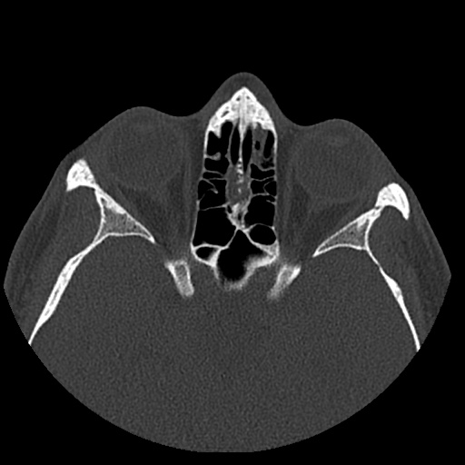 Normal CT paranasal sinuses (Radiopaedia 42286-45390 Axial bone window 42).jpg
