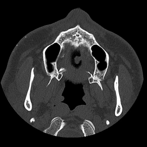 Normal CT paranasal sinuses (Radiopaedia 42286-45390 Axial bone window 94).jpg