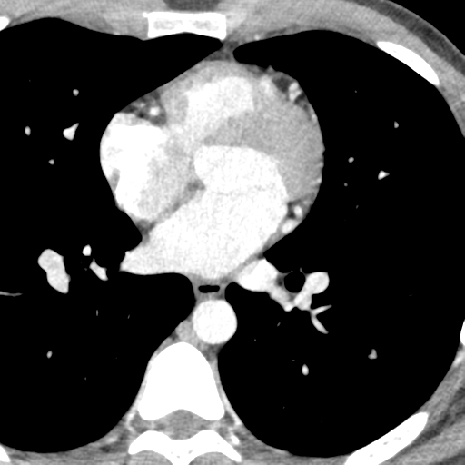 File:Normal CT pulmonary veins (pre RF ablation) (Radiopaedia 41748-44702 A 173).png