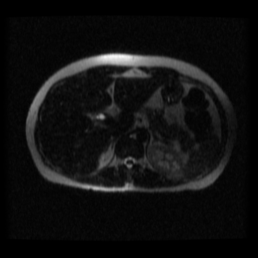 File:Normal MRCP (Radiopaedia 41966-44978 Axial T2 thins 23).png