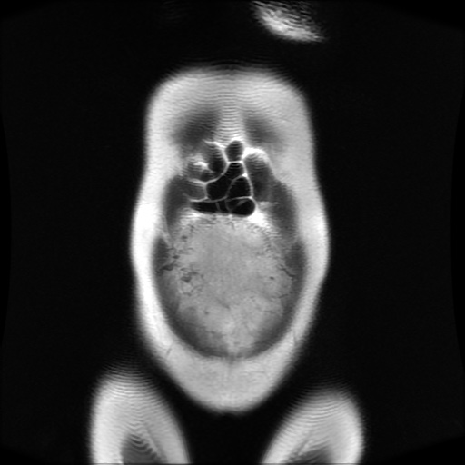 File:Normal MRI abdomen in pregnancy (Radiopaedia 88001-104541 Coronal T2 6).jpg