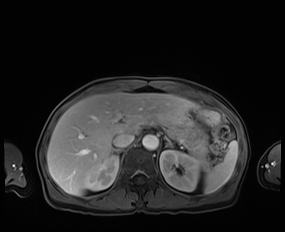 Normal adrenal glands MRI (Radiopaedia 82017-96004 K 24).jpg