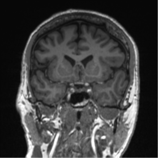 Normal brain MRI (non-focal epilepsy protocol) (Radiopaedia 53917-60040 Coronal T1 43).png