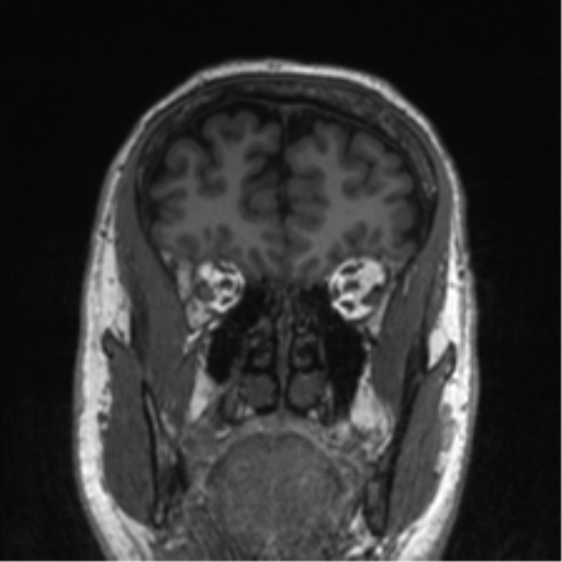 Normal brain MRI (non-focal epilepsy protocol) (Radiopaedia 53917-60040 Coronal T1 52).png