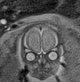 File:Normal brain fetal MRI - 22 weeks (Radiopaedia 50623-56050 Coronal T2 Haste 20).jpg