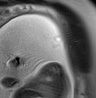Normal brain fetal MRI - 22 weeks (Radiopaedia 50623-56050 Sagittal T2 Haste 1).jpg