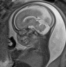 File:Normal brain fetal MRI - 22 weeks (Radiopaedia 50623-56050 Sagittal T2 Haste 13).jpg