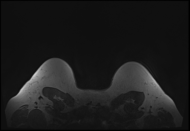File:Normal breast MRI - dense breasts (Radiopaedia 80454-93850 Axial T1 210).jpg