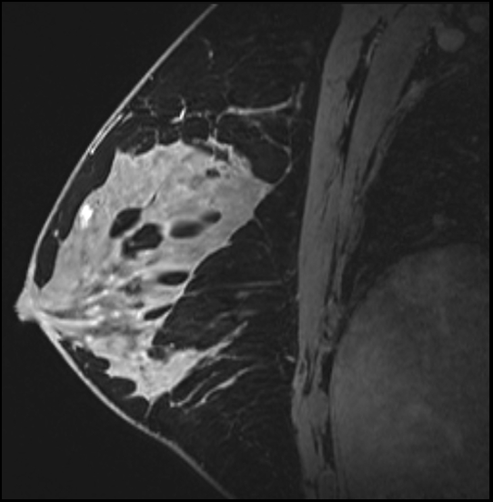 Normal breast MRI - dense breasts (Radiopaedia 80454-93850 I 106).jpg