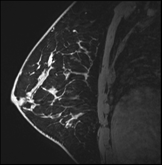 Normal breast MRI - dense breasts (Radiopaedia 80454-93850 I 122).jpg