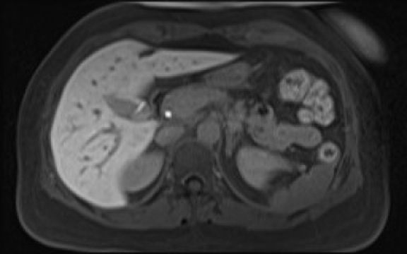 File:Normal hepatobiliary phase liver MRI (Radiopaedia 58968-66230 A 44).jpg