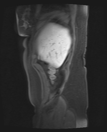 File:Normal hepatobiliary phase liver MRI (Radiopaedia 58968-66230 C 9).jpg