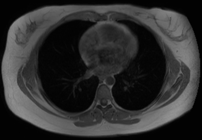 File:Normal liver MRI with Gadolinium (Radiopaedia 58913-66163 Axial T1 in-phase 35).jpg